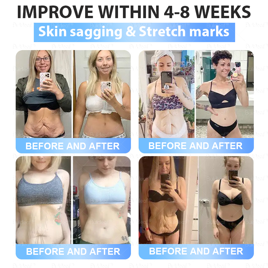 🏥FDA Store | 𝐵uil𝗱𝐿ea𝐟® 𝑺𝑀𝗚T-𝑮𝐋𝑃-1 𝐒limming & 𝐻ealth 𝑁ano 𝑀icroneedle 𝑃atch with Collagen & Matrixyl 3000 丨Obesity,Cardiovascular Diseas, Diabetes, Sleep Apnea, Joint Problems and More