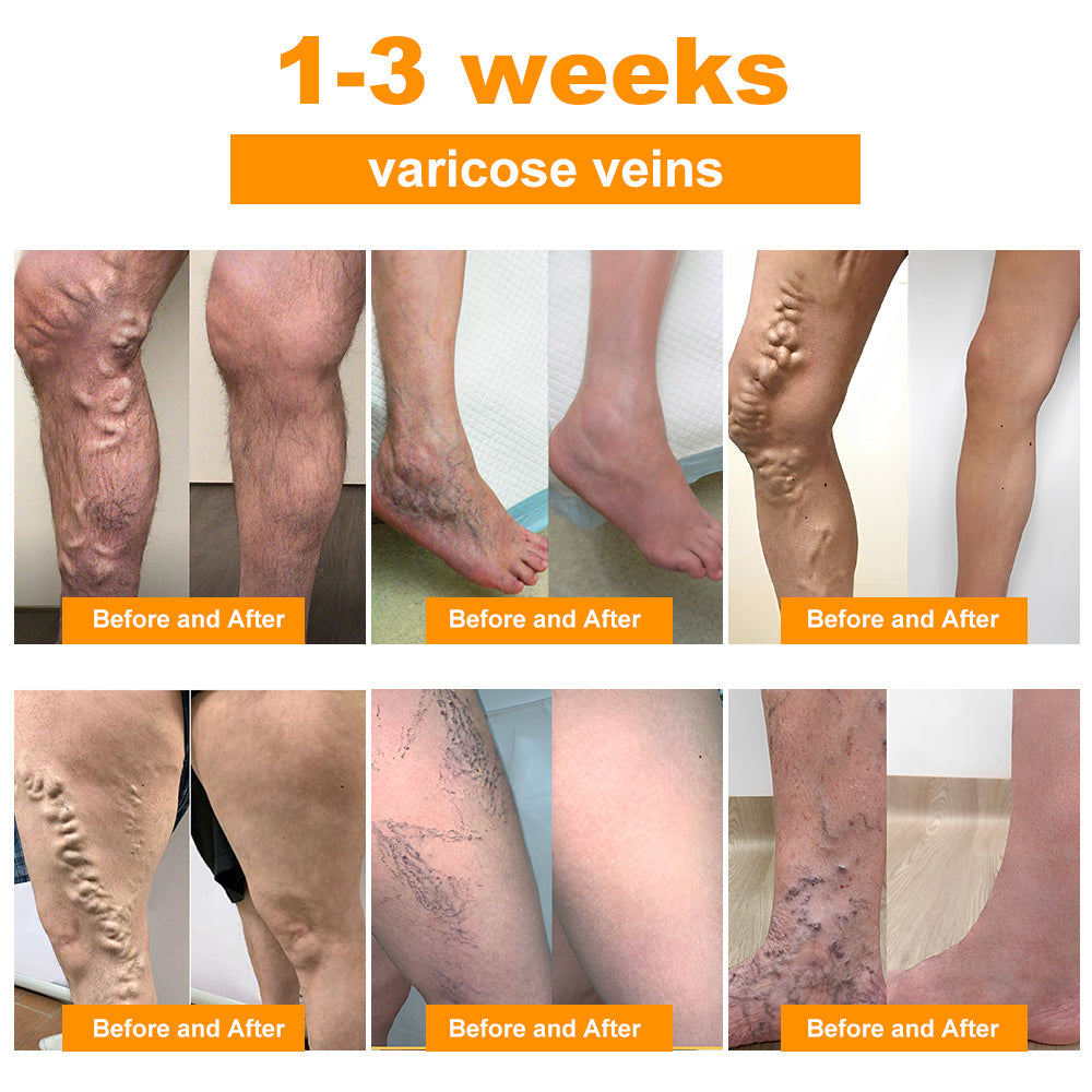 BeeGuard™🌿🌿 Bee Venom Lymphatic Drainage & Slimming Foot Soak Beads 70% Off 【Doctor Recommended - For All Lymphatic Problems and Obesity】
